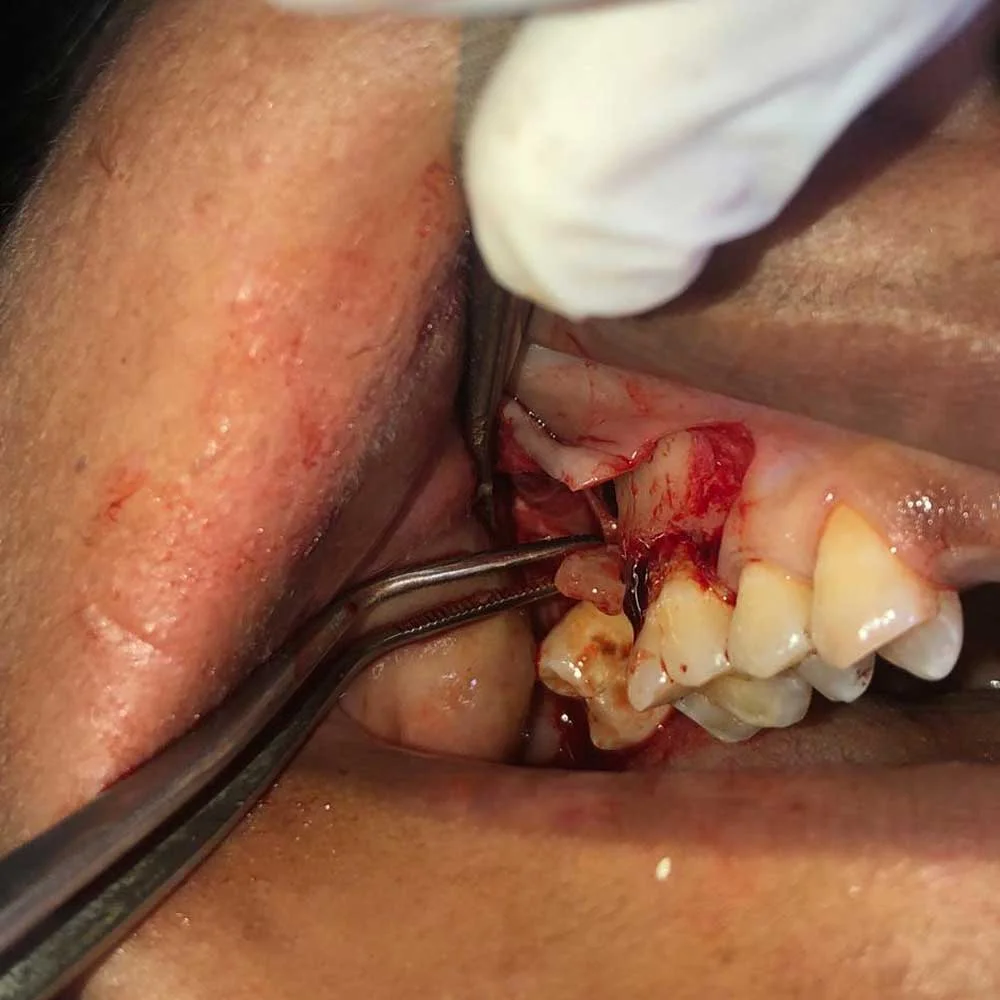 Dental Implants