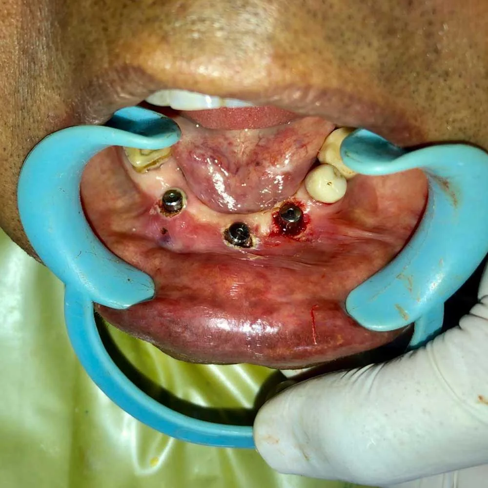 Dental Implants