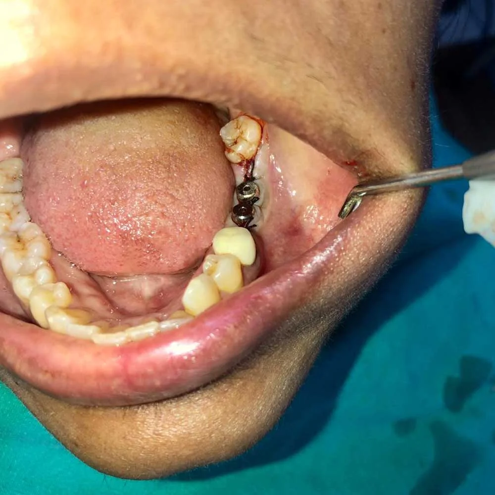 Dental Implants