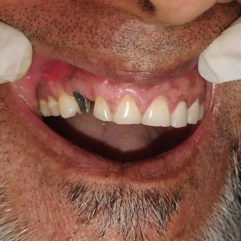 Dental Implants