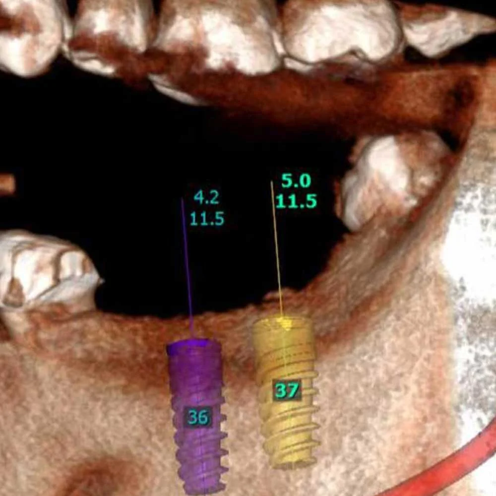 Dental Implants
