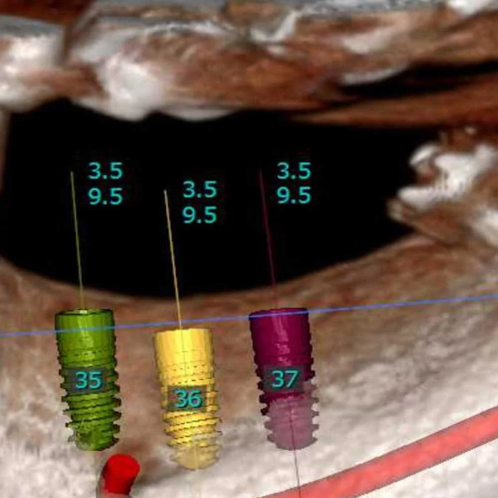 Dental Implants