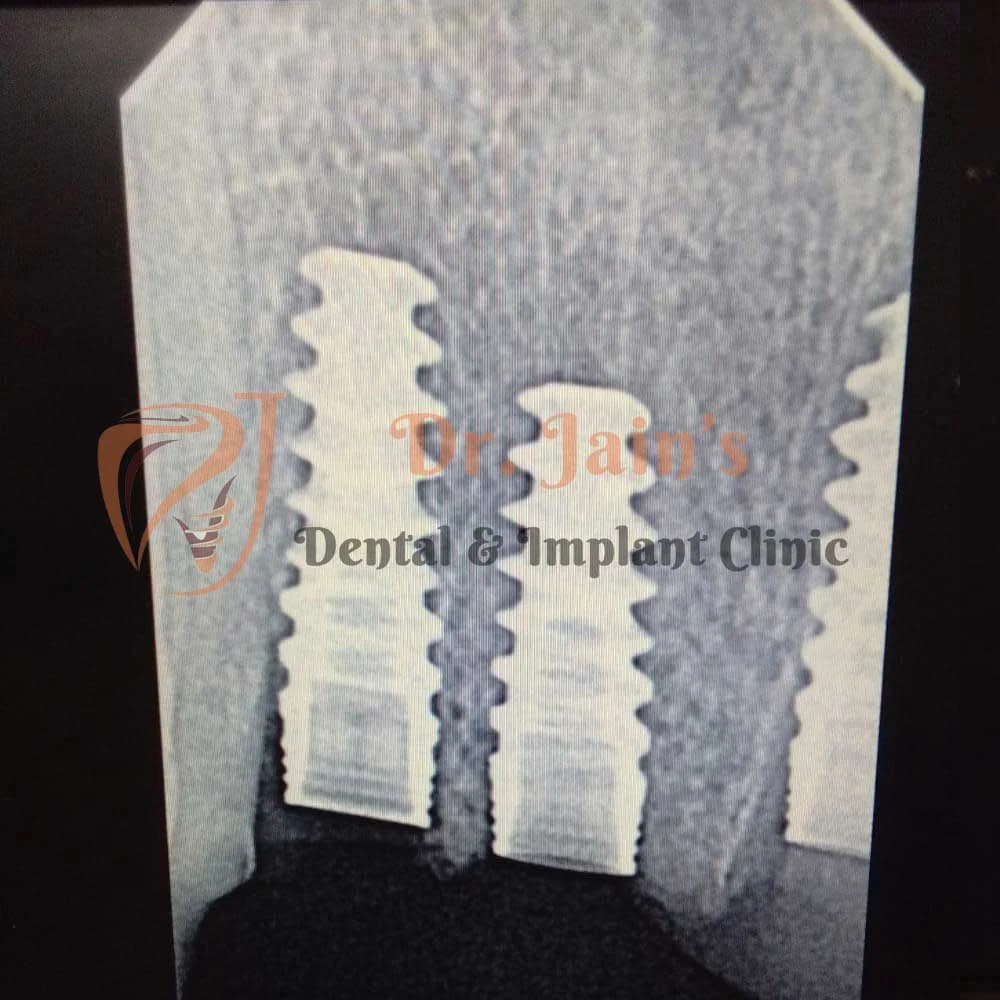 Dental Implants