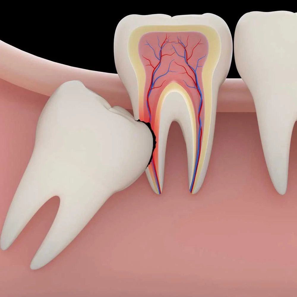 Wisdom Tooth