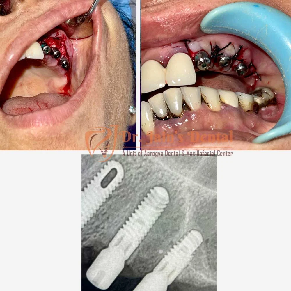 Immediate Dental Implants
