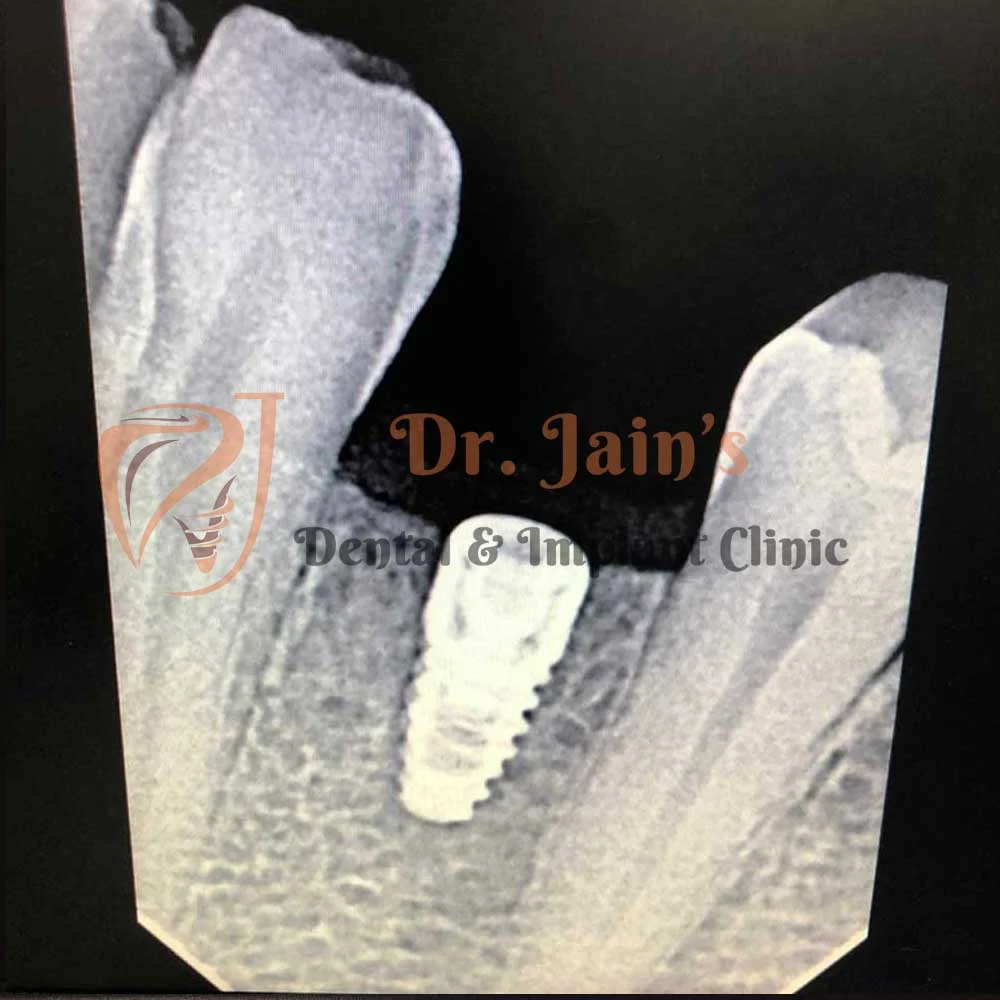 Dental Implants