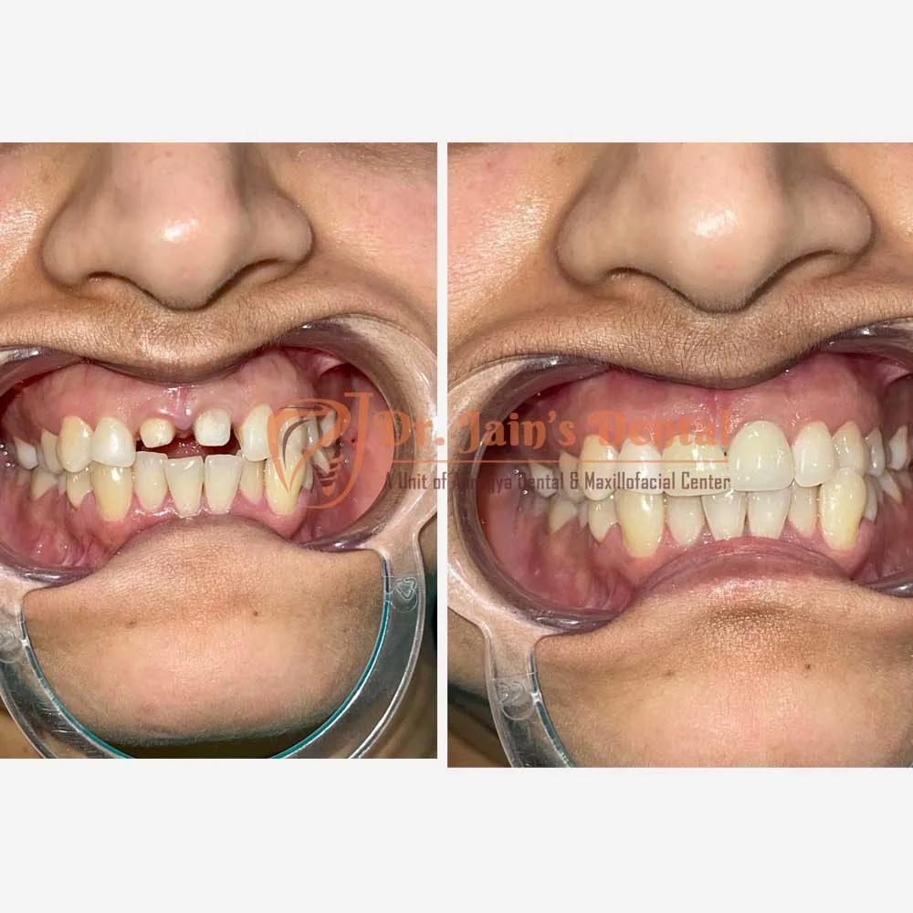 Immediate Implants & Metal Free Crowns