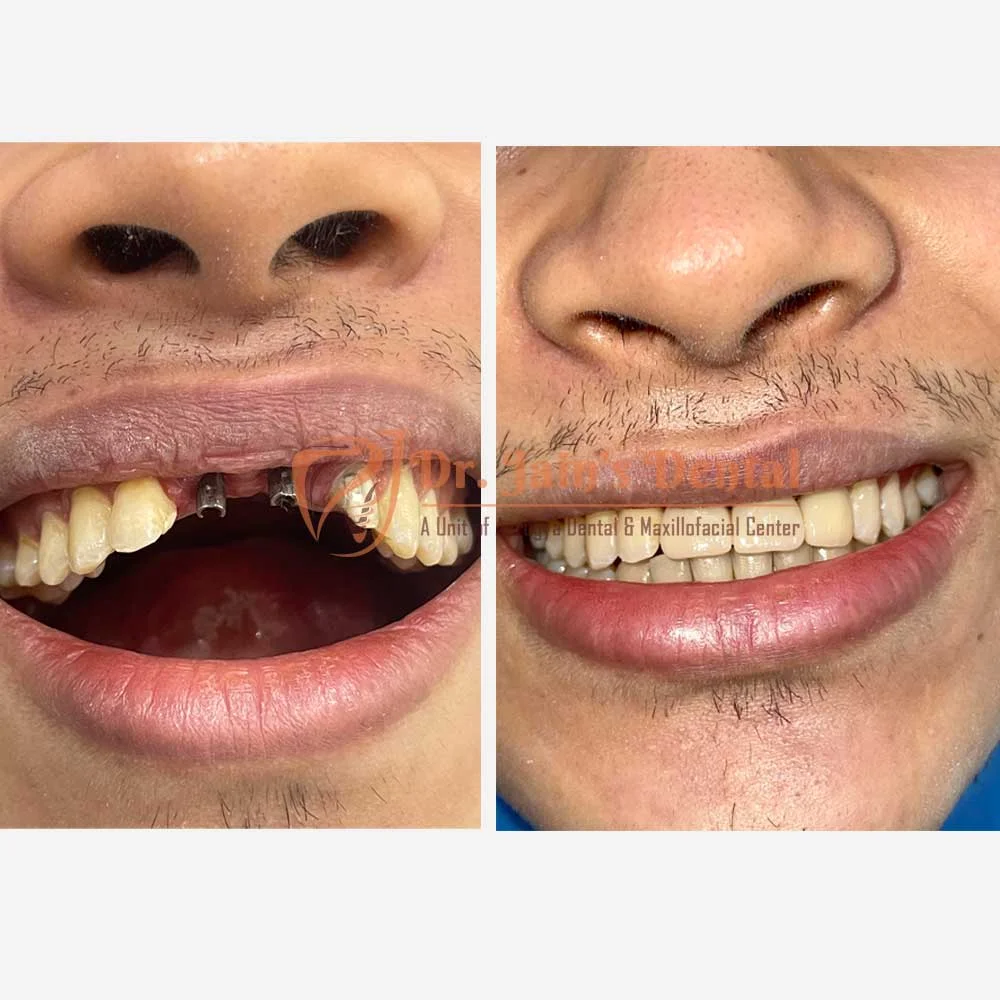 Immediate Implants & Metal Free Crowns