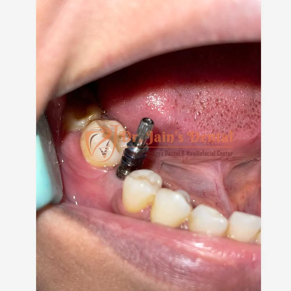 Implant Crowns